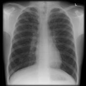 Chest x-ray of a person without cystic fibrosis