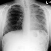 Chest x-ray of a patient with cystic fibrosis